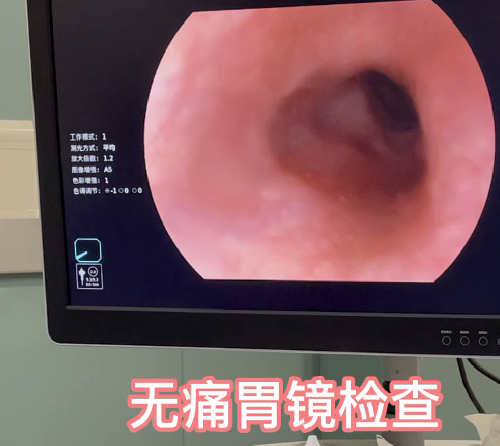 【内科（消化）科普】胃肠镜科普之反流性胃炎