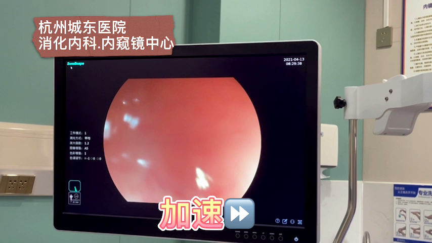 【内科（消化）科普】胃肠镜科普之肠道息肉